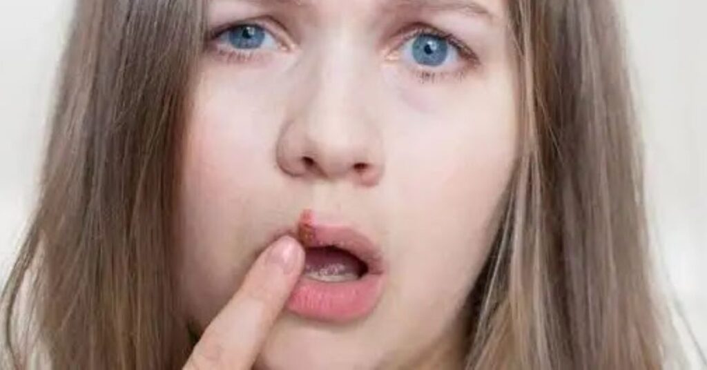 Salt On Cold Sore Overnight Treatment or Myth?