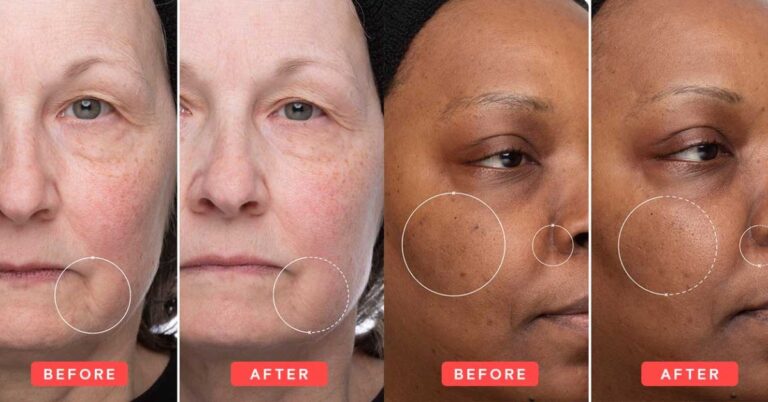 retinol before and after