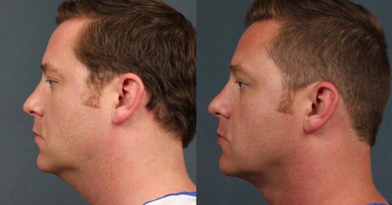 neck lift before and after