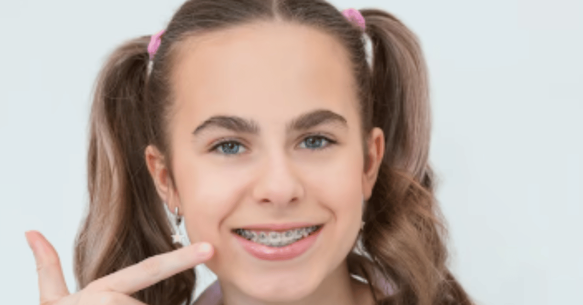 braces colors